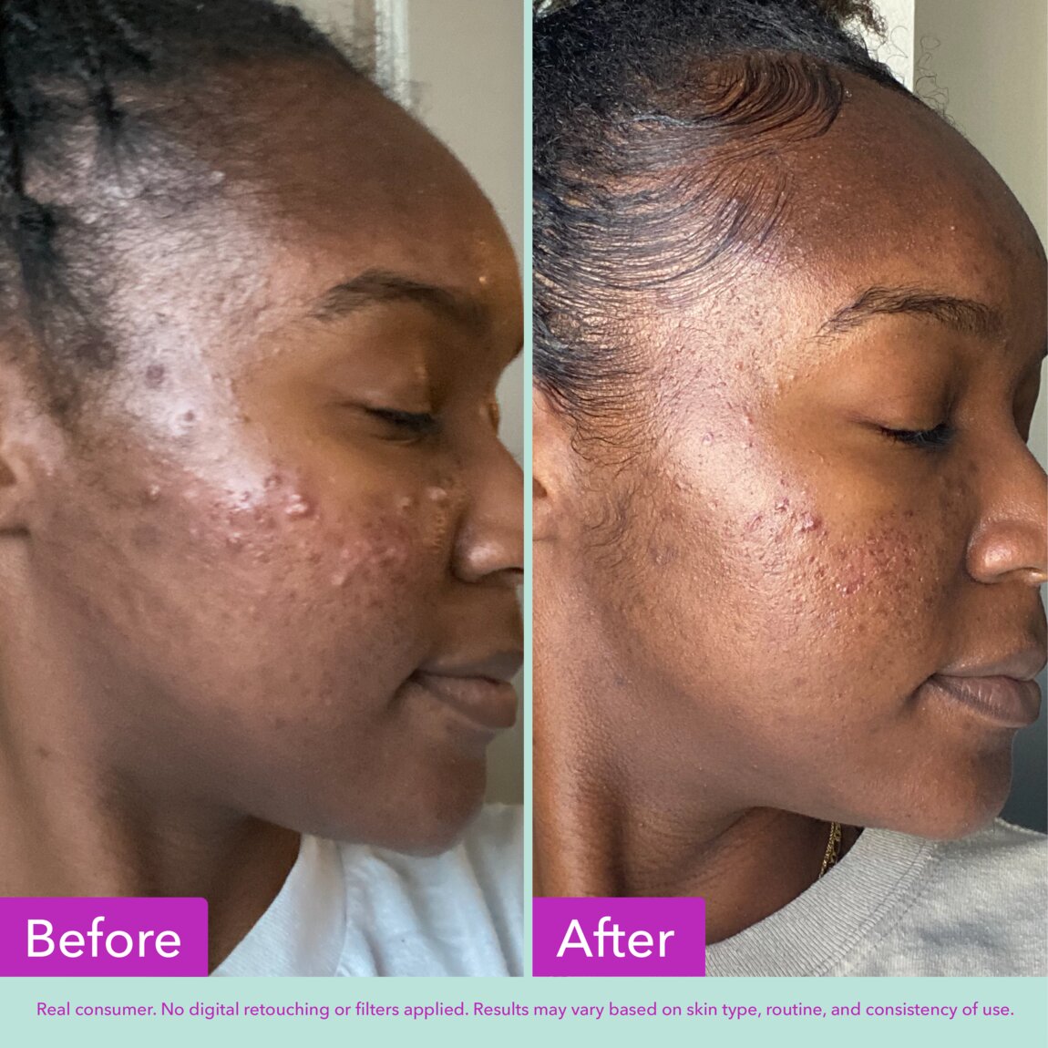 acne-foaming-cleanser-s4 zb_p.jpg