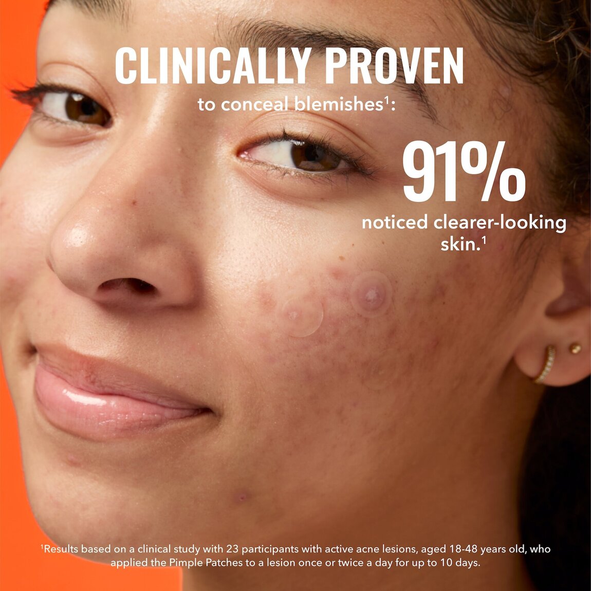 pimple-patches-g4 zb_p.jpg